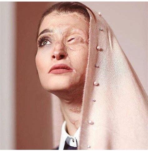 Tamerlanes Thoughts Marzieh Ebrahimi Iranian Acid Attack Victim