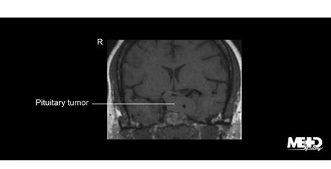 Pituitary Tumor Mri