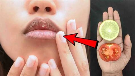 Restore Your Chapped Lips Naturallay And Remove Dry Lips Permanently At