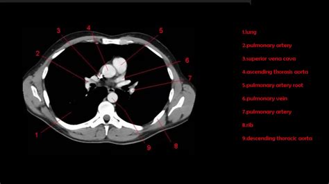 Ct Scan Images Of Chest