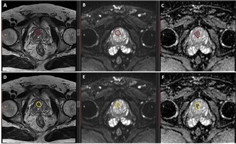 Frontiers Mri Radiomics In Prostate Cancer A Reliability Study