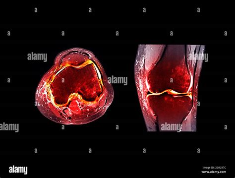 Imagerie Par R Sonance Magn Tique Ou Comparaison Des Articulations Du