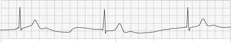 Six Second ECG Practice Quiz 2A - SkillStat