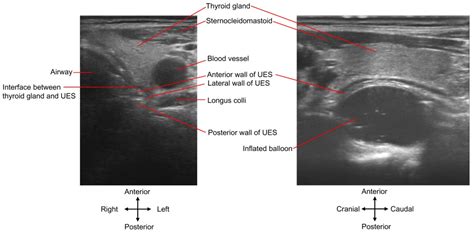 Ultrasonography Guided Botulinum Toxin Injection To The 41 Off