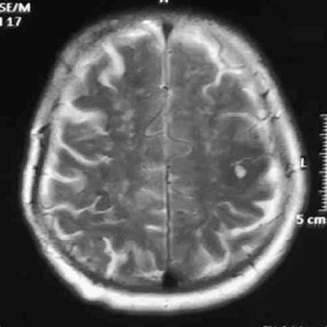 MRI brain axial view T2-weighted image showing left central sulcus ...