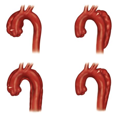 Dissec O De Aorta Tem Como Prevenir Mais Em Seucardio Br