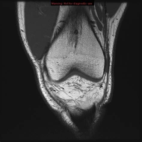 Knee Mri Coronal 2 Diagram Quizlet