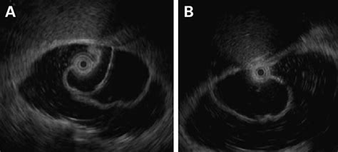 Endoscopic Ultrasonography A And B An Anechoic Lesion Located In The Download Scientific