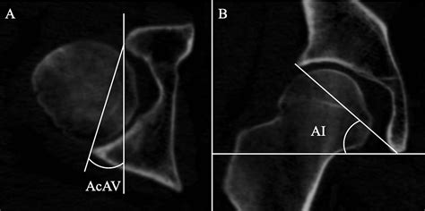 side  side variability   femoral neck anteversion angle  study