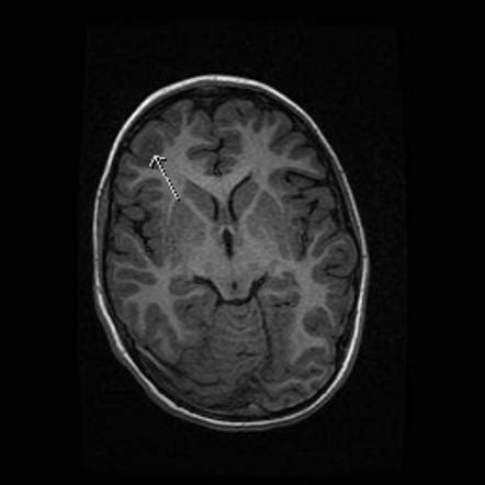 Focal cortical dysplasia | Radiology Reference Article | Radiopaedia.org