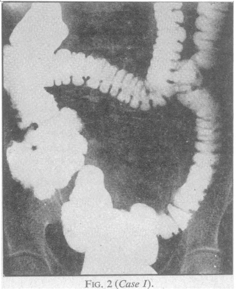 Figure 1 from The Diagnosis of Amœbic Colitis | Semantic Scholar