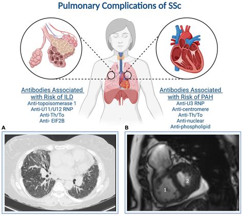 Frontiers Clinical Features Of Pulmonary Arterial Hypertension