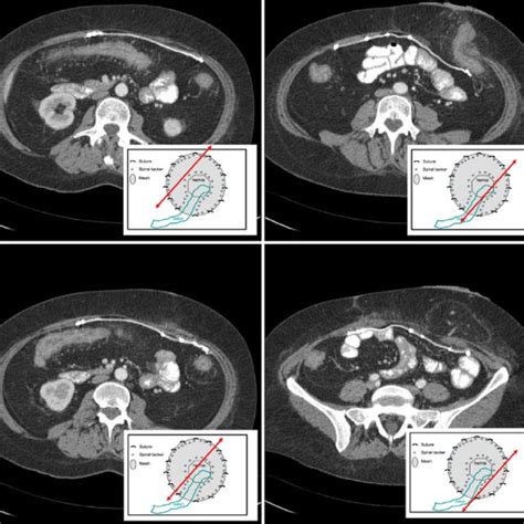 Postoperative Multislice Ct Scan After Laparoscopic Sugarbaker Repair