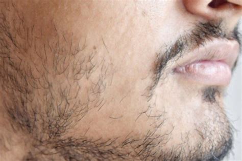 How To Fix A Patchy Beard Reasons And Solution Cosmetize Uk Patchy