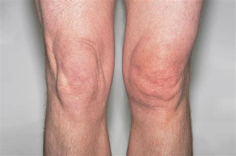 Prepatellar Bursitis Ph