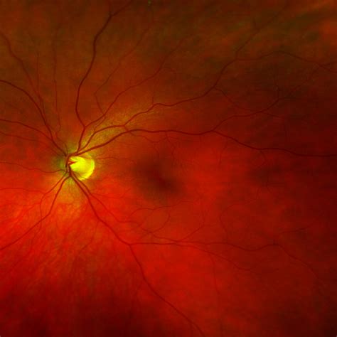 Secondary glaucoma - Kersley Eye Clinic London