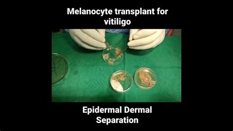 Melanocyte Transplant Vitiligo Surgery Youtube