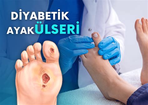 Diyabetik Ayak Ülseri Turan Turan