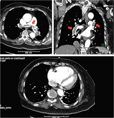 Computed Tomography Angiogram Of The Chest Large Saddle Pulmonary