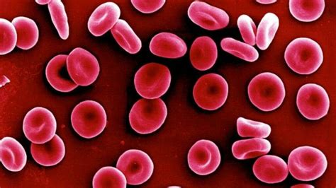 Microcytic Anemia: What Is Microcytic Anemia?