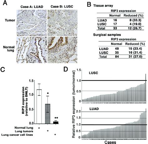 Rip Expression Is Reduced In Nsclc A Human Lung Tumors With Paired