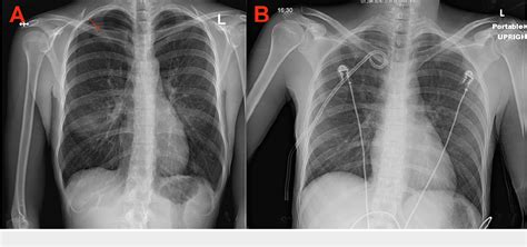 PDF A Rare Case Of Catamenial Pneumothorax And A Review Of The