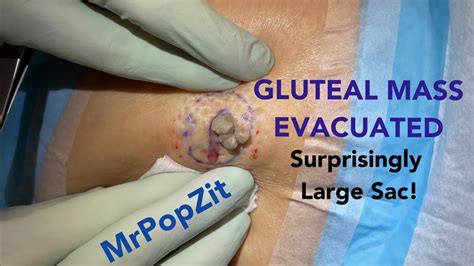 Giant Pilar Cyst Multiple Cysts On Scalp Sac Removal Coming Soon