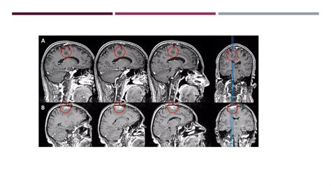 MRI Epilepsy protocol | PPT