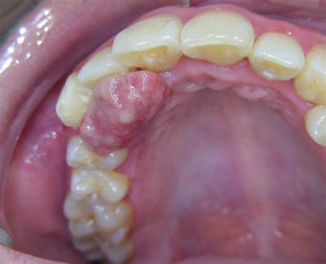 Patología Bucal Maxilofacial Osorno