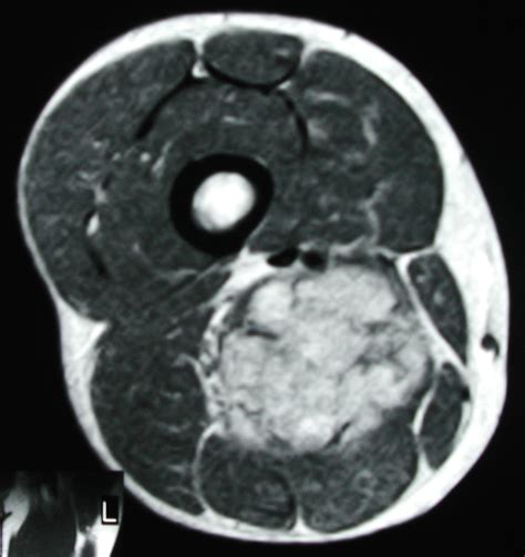 Preoperative Embolization Case Albany Ir