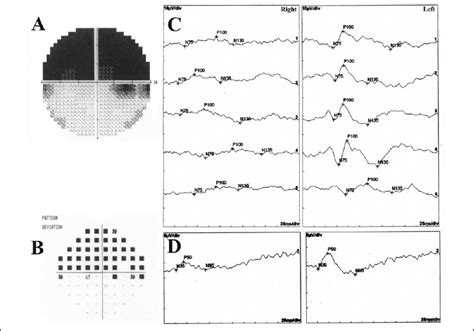 (A, B) Automated perimetry showing superior altitudinal visual field ...