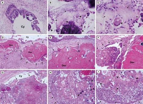 Calcifying Epithelial Odontogenic Tumor Histology