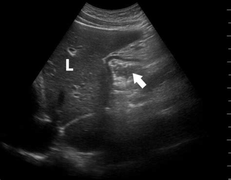 Gastric Point Of Care Ultrasound OpenAnesthesia