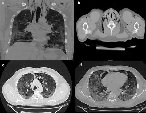 Spontaneous Pneumomediastinum In Patients Diagnosed With Covid 19 A