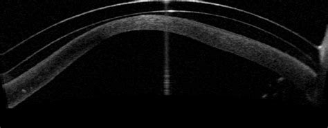 Keratoconus Photo Gallery