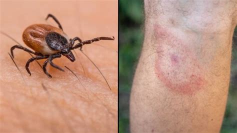 Rare Tick Borne Disease Has Been Discovered In England