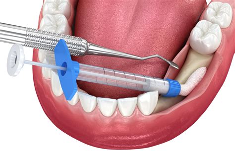 San Antonio Jaw Bone Augmentation Sinus Lift Advanced Periodontics