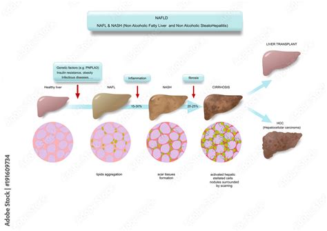 Various Stages Of Fatty Liver Disease Nafld Stock Illustration Adobe Stock