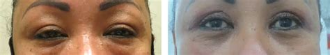 4 Lid Blepharoplasty Before And After Photo Gallery A Rabinovich