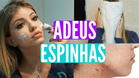 Truques Para Se Livrar Das Espinhas Pomada Milagrosa Contra Acne E