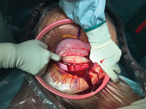 Cesarean Section Technique With Diagram