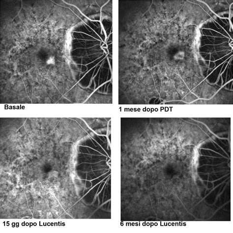 Domande E Risposte Sulle Iniezioni Intravitreali