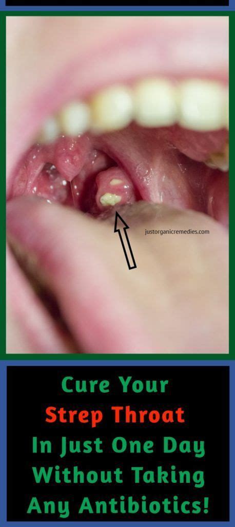 12 Effective Natural Home Remedies To Treat A Strep Throat Infection