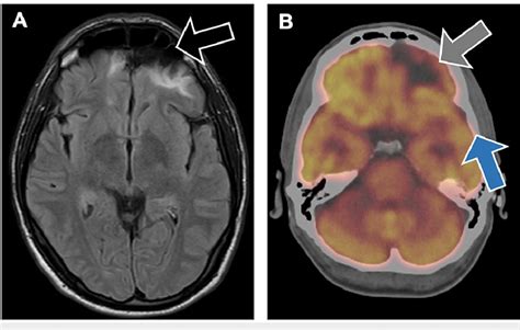 Frontal Lobe Injury Symptoms Infoupdate Org