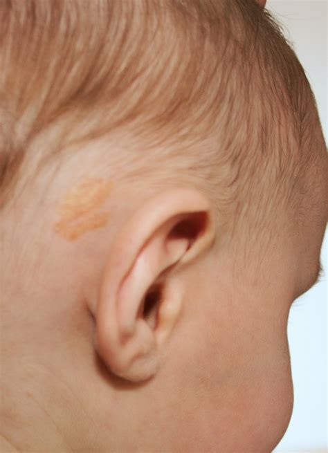 Nevus Sebaceous