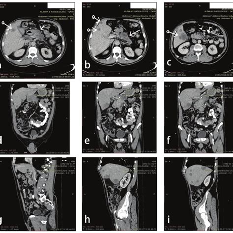 Multidetector Computed Tomography Axial Plane A B C Coronal Plane