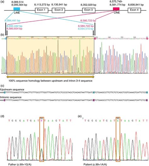 Definition Of The Genomic Breakpoints Of The Deletion And Sequence