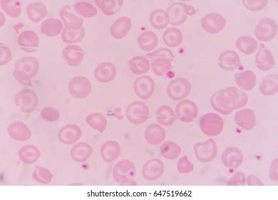 Thalassemia Blood Smear Abnormal Red Blood Stock Photo 1133424407