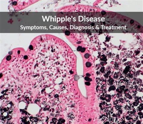 Whipple’s Disease: Symptoms, Causes, Diagnosis & Treatment