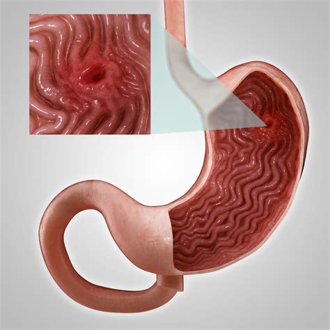 Causes Of Chest Pain Peptic Ulcer Disease